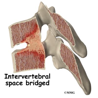 A Patient’s Guide to Spondyloarthropathy | Houston Methodist