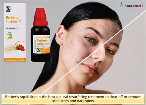 Best homeopathy medicines for acne by indications in pills, drops – Homeomart