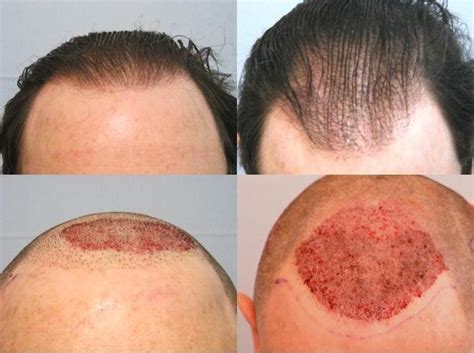 Hair Transplantation Clinics: June 2013