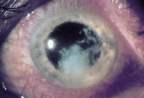 Fungal Keratitis - Europe - American Academy of Ophthalmology