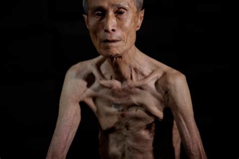 Japanese atomic bomb survivor Sumiteru Taniguchi reveals scars which still cause pain 70 years ...