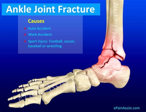 Ankle Fracture - Welk Security & Trust