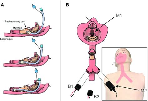 Diagram of the airway showing intubation tube placement and ...