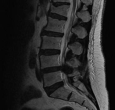 Lumbosacral Apl X Ray / Lumbar Spine Flexion And Extension Views Radiology Reference Article ...