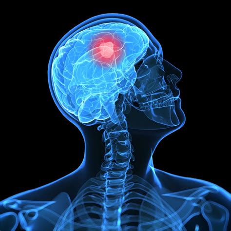 An Overview of Glioblastoma Multiforme