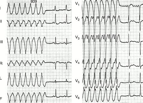 Wide Qrs Complex Tachycardia