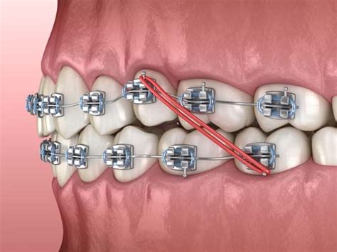 Corrective Braces For an Overjet - Henry Orthodontics Pinehurst, North Carolina