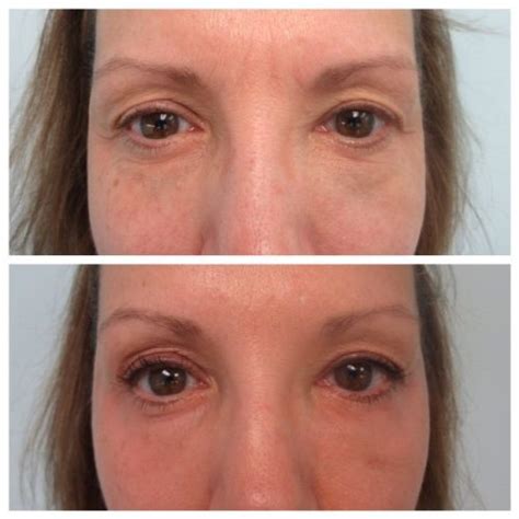 Eye Rejuvenation in Chevy Chase, MD & Washington DC | The West Institute