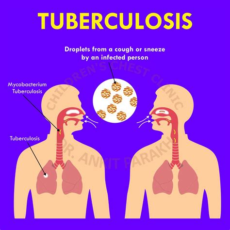 Tuberculosis: Spreads by Cough - Dr. Ankit Parakh