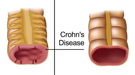 Crohns Disease: Symptoms, Causes, Diagnosis, and Treatment