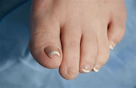 Ingrown Toenail Treatments - Beaver Valley Foot Clinic