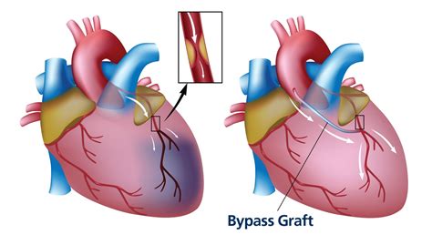 Coronary Artery Bypass Grafting (CABG) | Coronary Artery Surgery