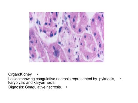 Organ:Kidney Lesion:showing coagulative necrosis represented by pyknosis, karyolysis and ...