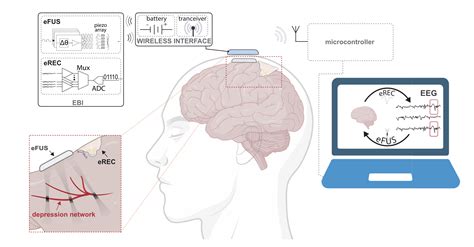 Focused ultrasound for major depressive disorder