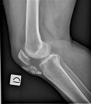 Prepatellar bursitis | Radiology Reference Article | Radiopaedia.org