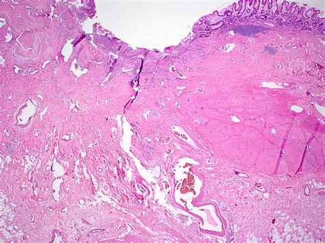 Pathology Outlines - Arteriovenous malformation