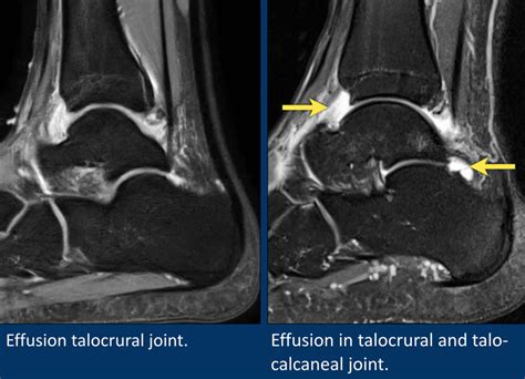 Foot Muscles Mri - Accessory Muscles Of The Ankle Radsource - Use your muscles to pull them away ...