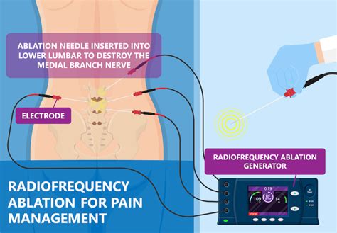 Radiofrequency Ablation Surgery – Laser Spine Center