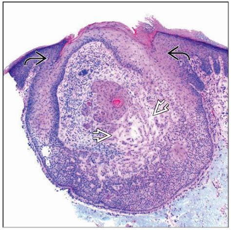 Tricholemmoma | Basicmedical Key