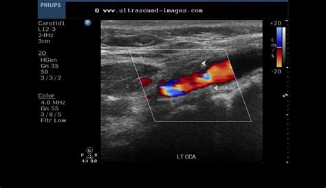 Ultrasound imaging: Carotid artery atherosclerotic plaques- moderate stenosis