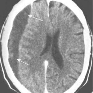 Subdural hematoma | The Trauma Pro