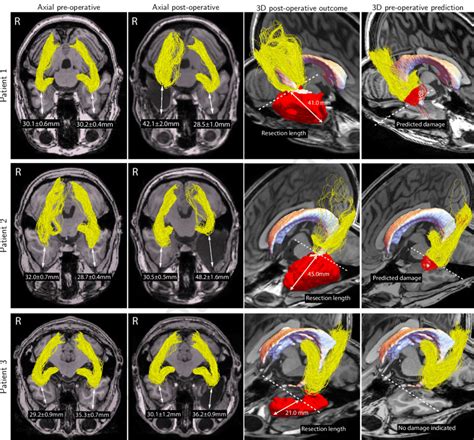 Tractography and distance measurement results for the three patients ...