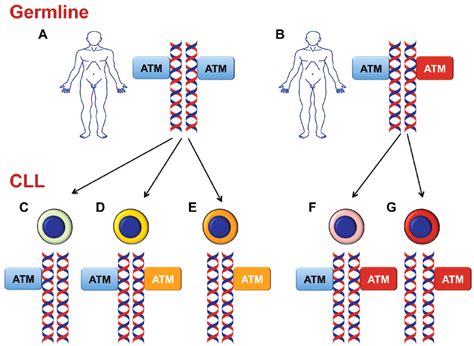 ATM and chronic lymphocytic leukemia: mutations, and not only deletions, matter | Haematologica