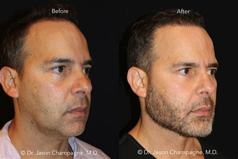 How to Fix a Weak Chin or Jawline - Custom Chin and Jaw Implants ...