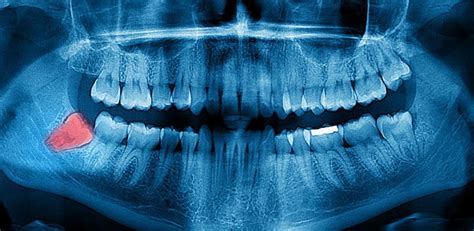 Digital Dental X-Rays, Diagnostics | Dreamland Dental & Orthodontics