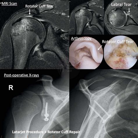 Latarjet Procedure | Shoulder Surgery | Sydney Shoulder Unit