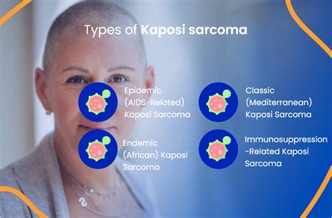 Understanding Kaposi Sarcoma: Causes, Symptoms, and Treatment - Byrd ...