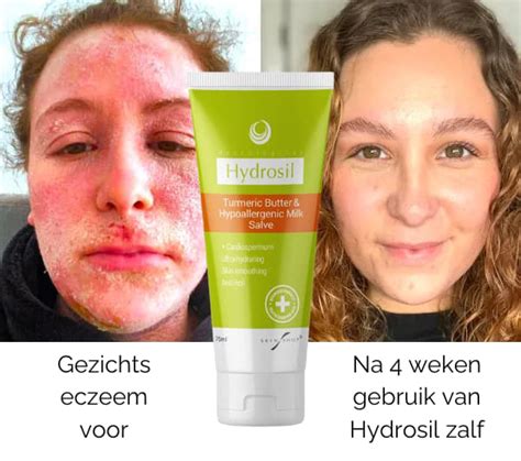 Beste natuurlijke crème voor eczeem als alternatief voor steroïde crème - Nisim