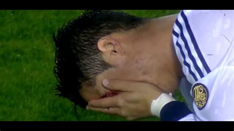 Ronaldo eye injury - YouTube