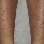 Follicular Eczema - Causes, Symptoms, Treatment, & Prevention