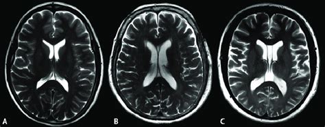 Axial MRI of cavum septum pellucidum (CSP) in a study subject a | Download Scientific Diagram