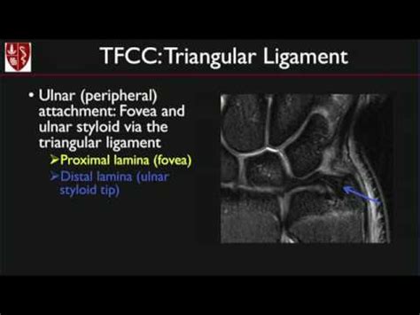 MRI of the Wrist: Ligaments and Triangular Fibrocartilage Complex, by ...