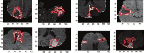 Examples of recurrent GBM tumors on MR images. The contours show the ...