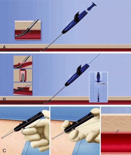 Basilic and Femoral Vein Transposition | Thoracic Key