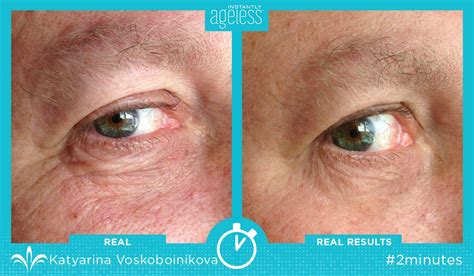 Instantly Ageless™ Before and After Photo Gallery, Jeunesse Global