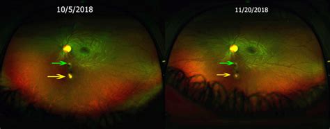 Toxoplasmosis Retinochoroiditis with Wide Angle Color Fundus - The ...