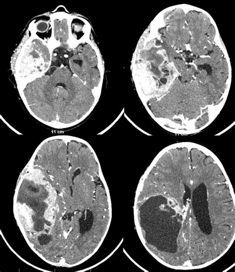 A contrast-enhanced computed tomography scan two months after the first... | Download Scientific ...