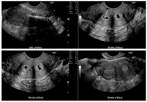 Didelphys Uterus Ultrasound