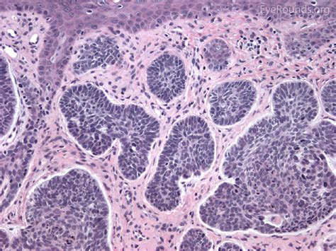 Malignant Lesions of the External Periocular Tissues Tutorial