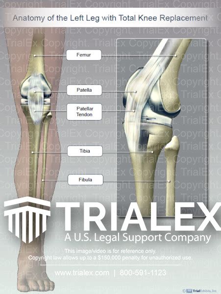 Anatomy of the Left Leg with Total Knee Replacement - Trial Exhib...