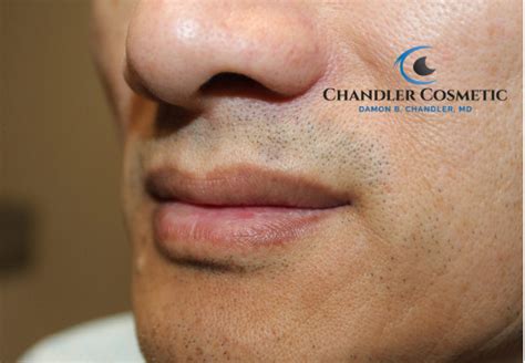 Mole on Lip | Lip Mole Removal - Chandler Cosmetic