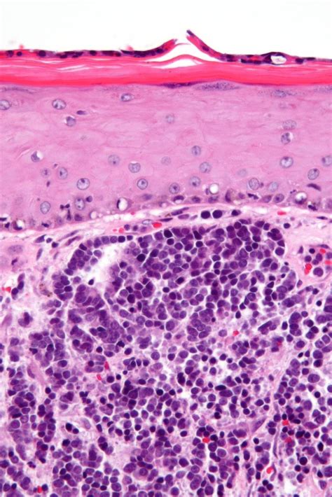 Stages of Merkel Cell Carcinoma | SERO