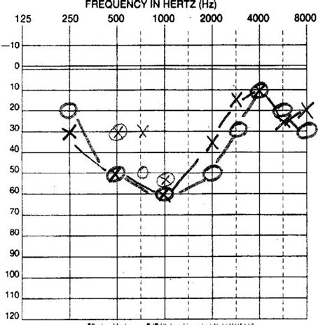 LOW FREQUENCY SENSORINEURAL HEARING LOSS