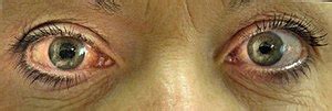 Glaucoma | Signs,symptoms and Treatment | Iranian Surgery