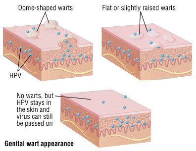 Genital Warts Guide: Causes, Symptoms and Treatment Options