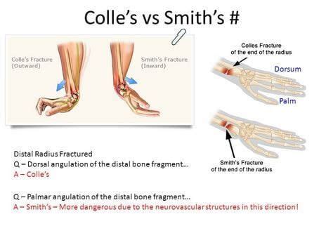 Image result for smith fracture | Basic anatomy and physiology, Body anatomy, Medical knowledge